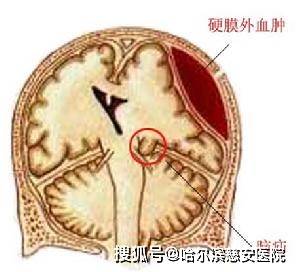 于头皮内的具体层次可分为皮下血肿,帽状腱膜下血肿和骨膜下血肿三种