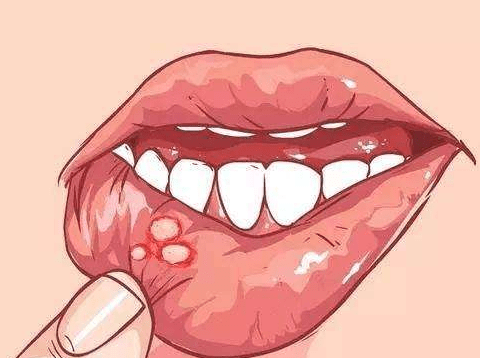 口腔溃疡复发性强如何有效预防