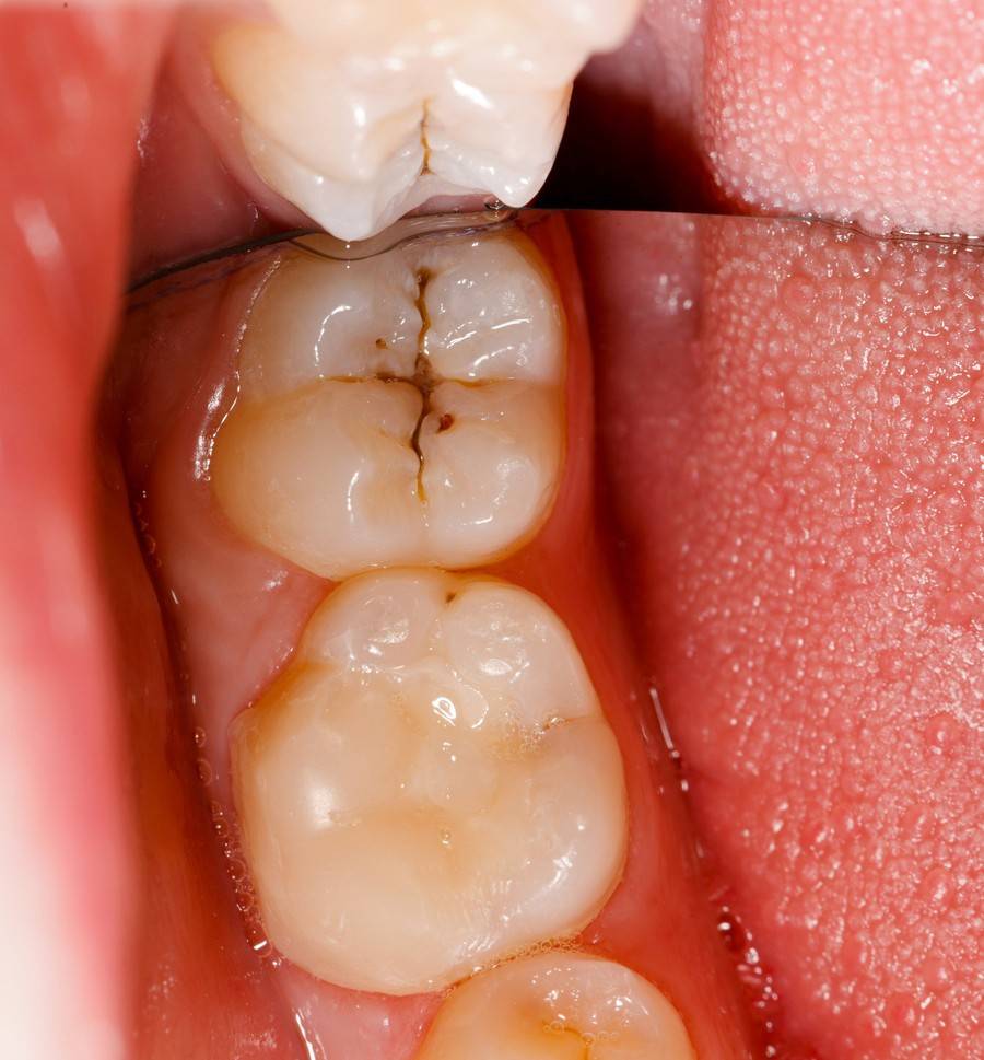 牙周疾病是导致低体重婴儿出生的多种危险因素之一,重症牙周炎的孕妇