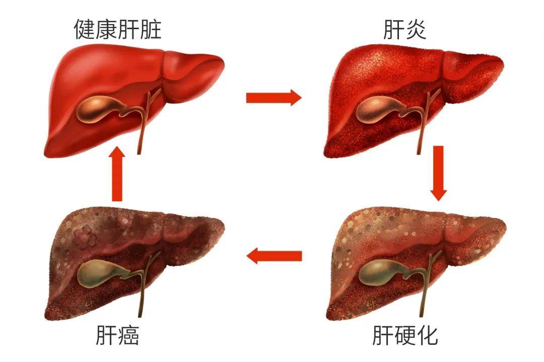 檢查:乙肝肝硬化的病人,最好每三個月～半年體檢一次,主要查肝臟b超和