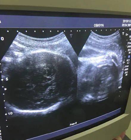 孕早期b超图解初期图片