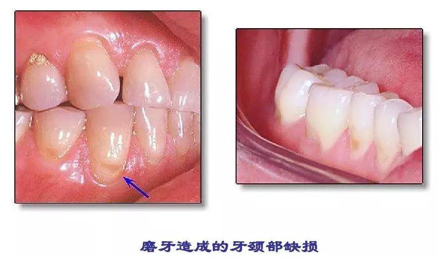 磨牙症的临床症状和治疗手段
