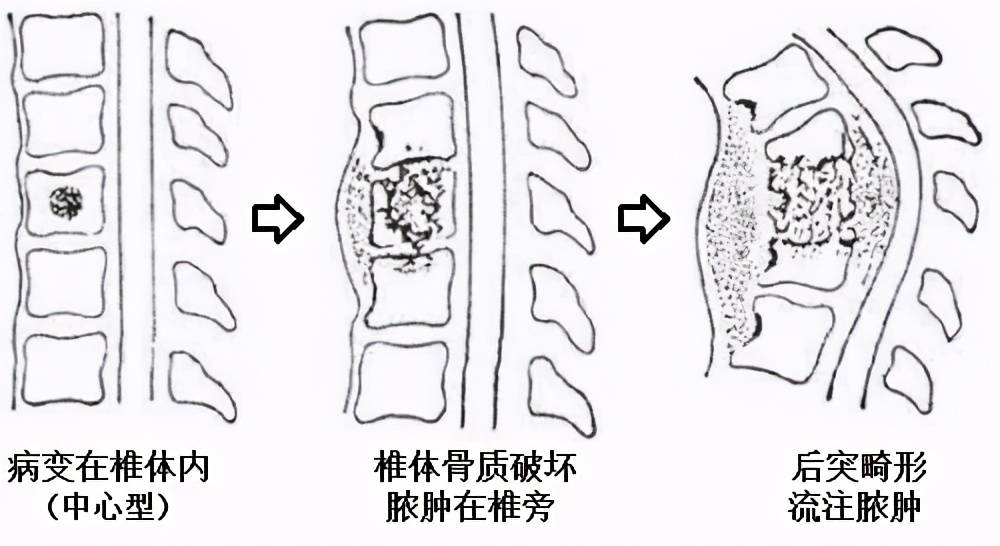 脊柱结核什么时候需要手术治疗?