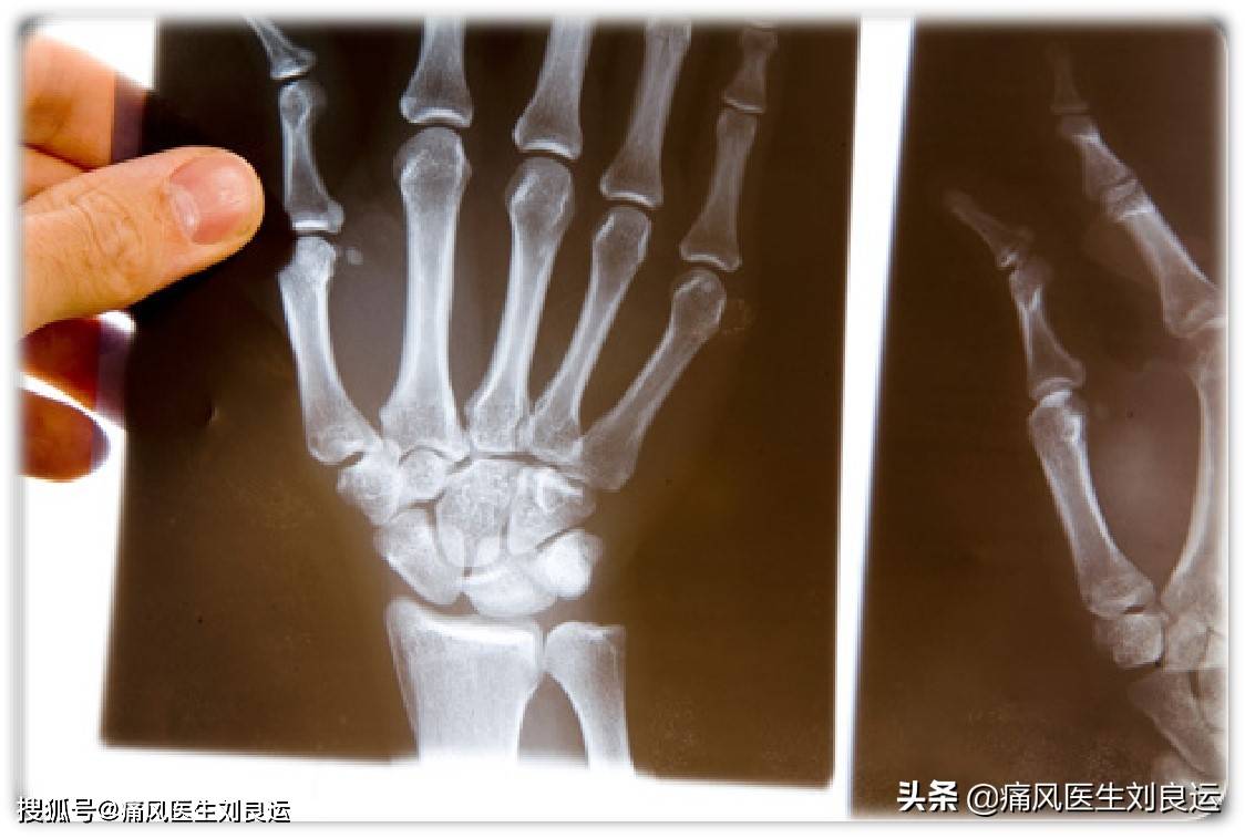 男易痛风女易患类风湿?关节炎不对症可能让您"走错门"和治错病