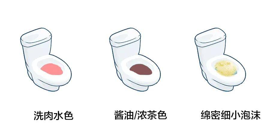 量异常,面部,小腿长期水肿,都应及时就诊; ● 观察到尿液出现洗肉水色