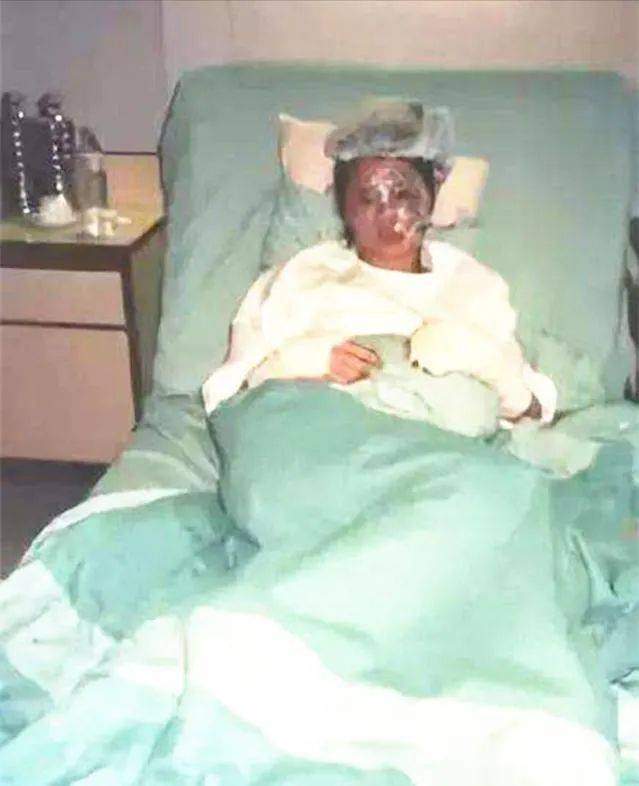 李赛凤在拍摄现场直接被烧伤,因为这次事故,李赛凤差点毁容