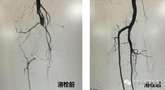 下肢動脈栓塞情勢急,動脈置管溶栓創奇蹟!_血管