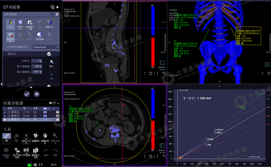 新技术|全景医学影像双源ct在泌尿系统结石分析中应用_手机搜狐网