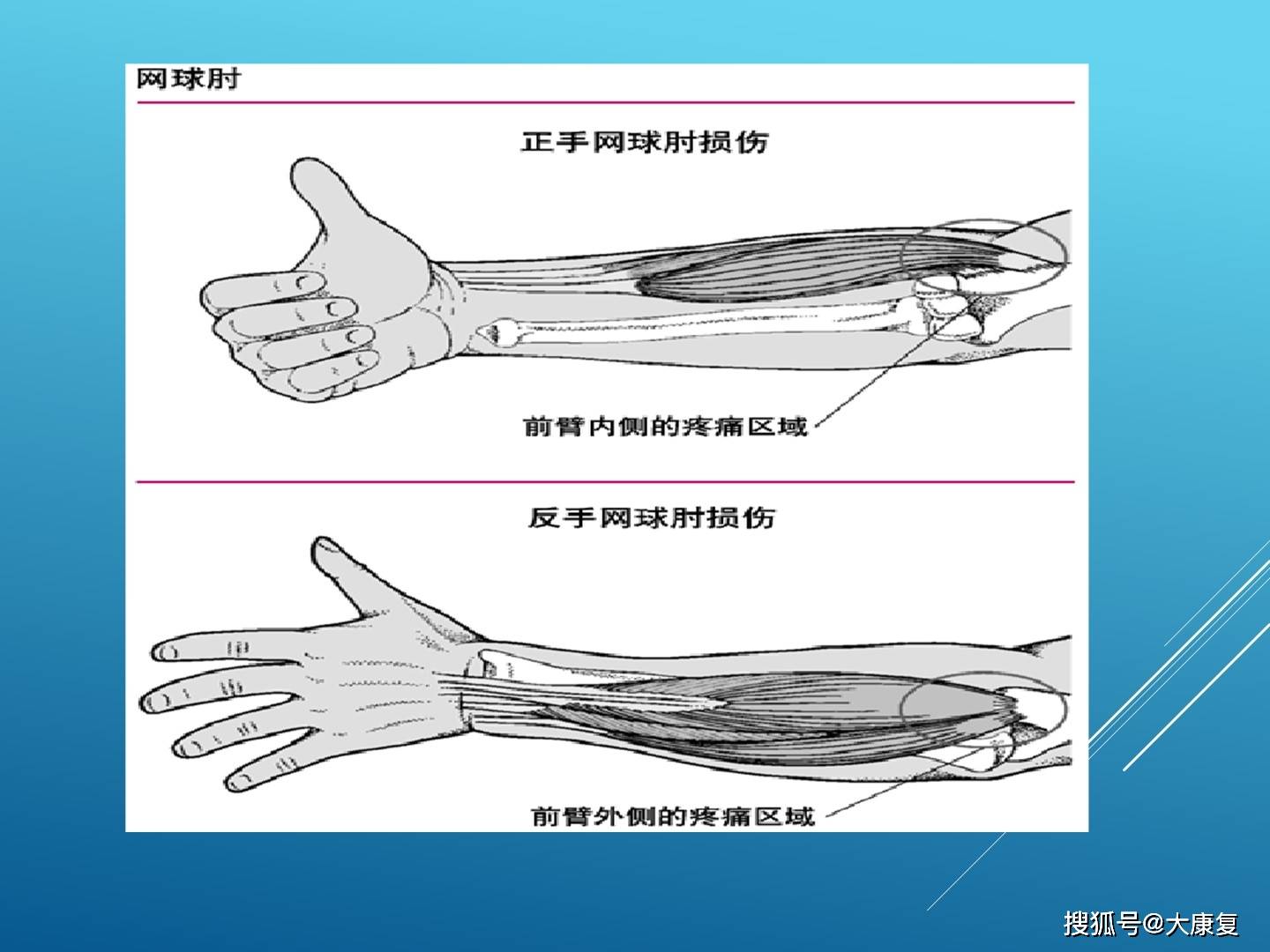 网球肘 解剖图图片