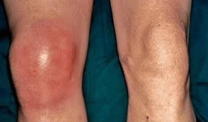 膝盖滑膜炎怎么治疗最好 66cd7c457287427d8cc2c8a6e77db50c.png