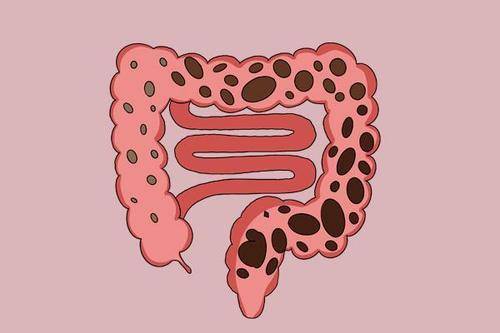 腸癌來臨,有啥異常?