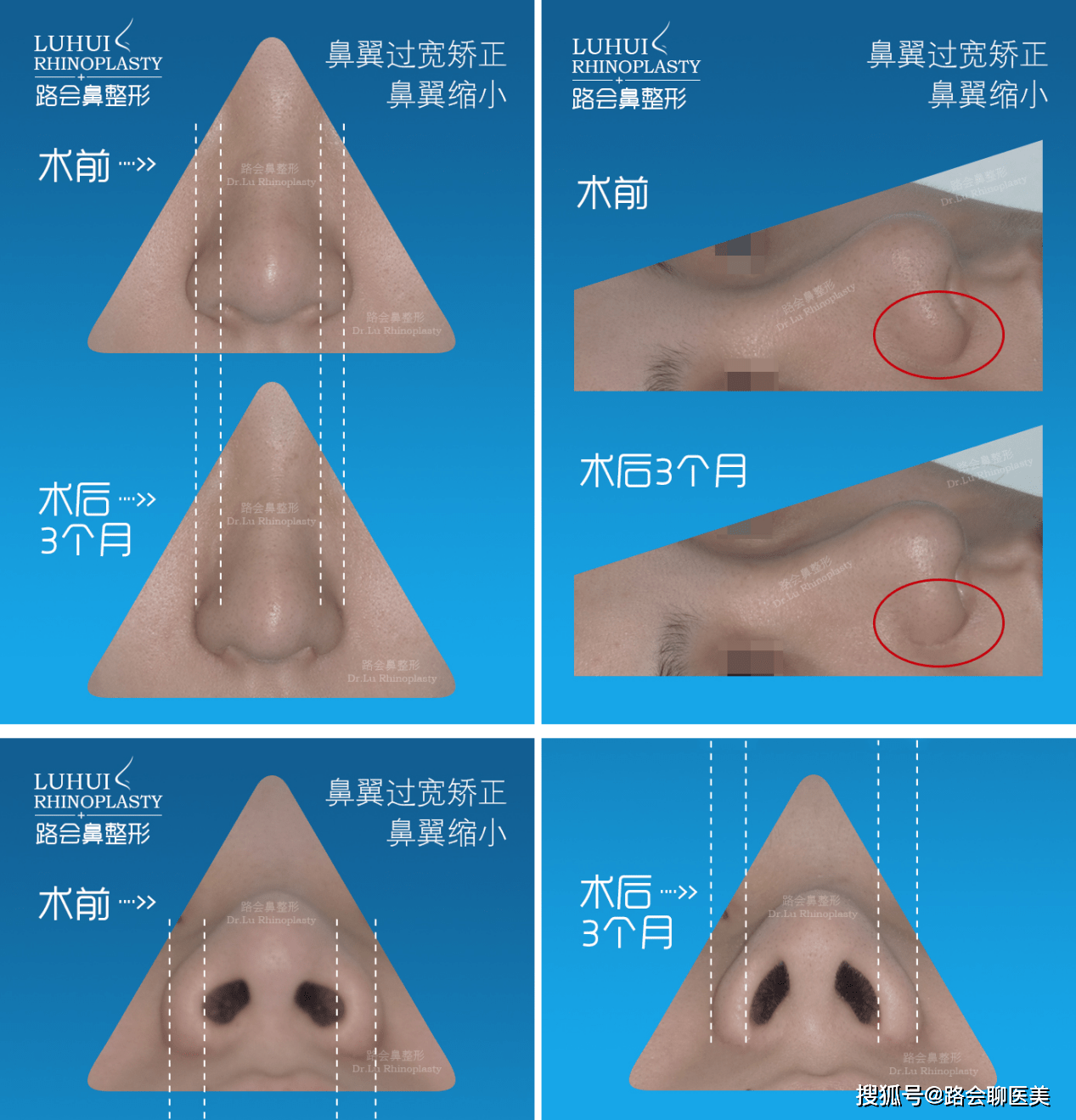 鼻头大鼻翼宽怎么办