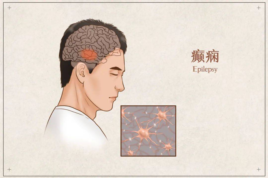 癫痫发作时因为大脑神经元异常放电所导致的脑功能一过性紊乱,严重的