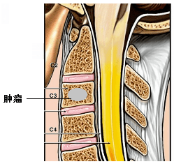 脊柱轉移瘤是指身體其他部分的惡性腫瘤轉移到脊柱形成的腫瘤