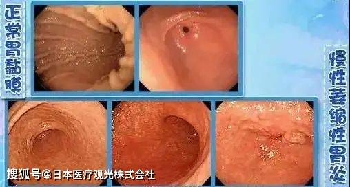 人口萎缩_牙龈萎缩图片(2)