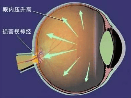 自己怎么测眼压高不高 c284c35fc15e4409bd5b9c1187b24f74.png