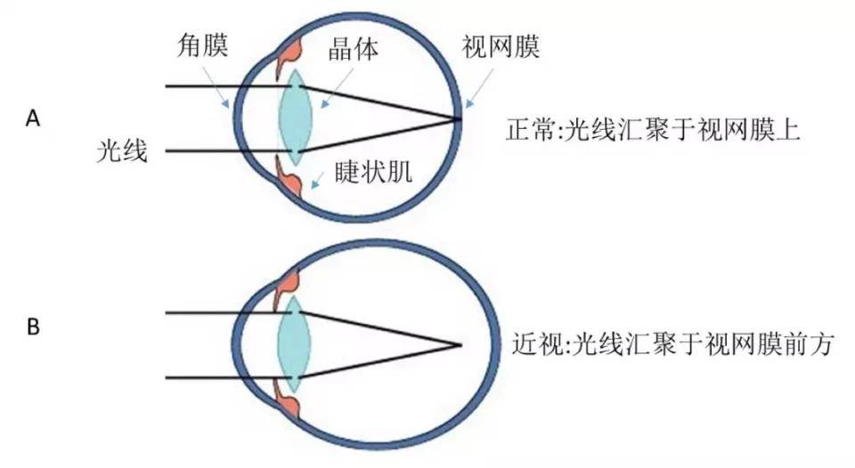 手术治疗近视是什么原理_近视激光手术原理图解