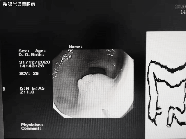 检查正常,结果是晚期肠癌!后悔没做肠镜!