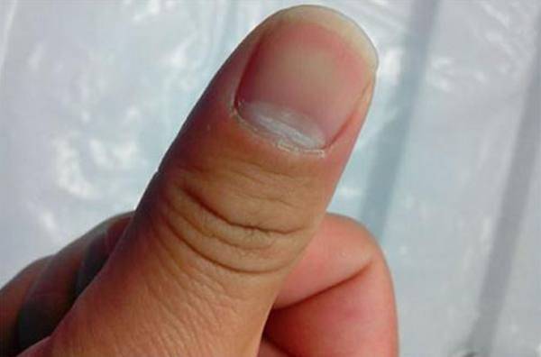不正常的指甲月牙图片图片