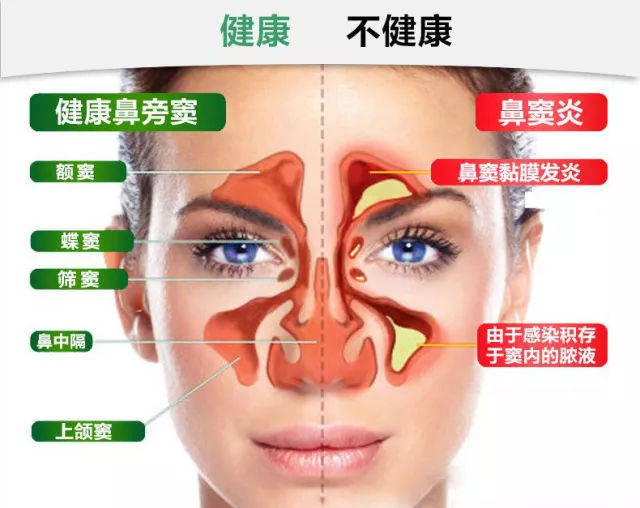 男子鼻塞,流鼻涕以为是感冒,没想到竟是鼻息肉,鼻窦炎
