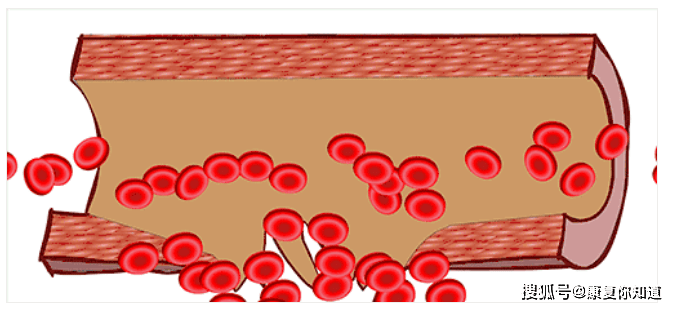 血管壁受损开始慢慢变薄正常的血管一种是血管失去弹性破损出血1,血管