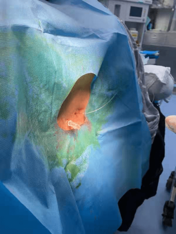 麻醉科陈刚主任对患者进行蛛网膜下腔阻滞麻醉操作