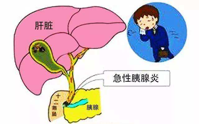 什么情况容易得胰腺癌 80b609f9f72c40cdaa681ac4e92e79aa.jpeg