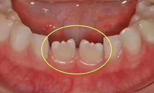 宝贝新牙成锯齿状,天生就发育不良?_牙齿