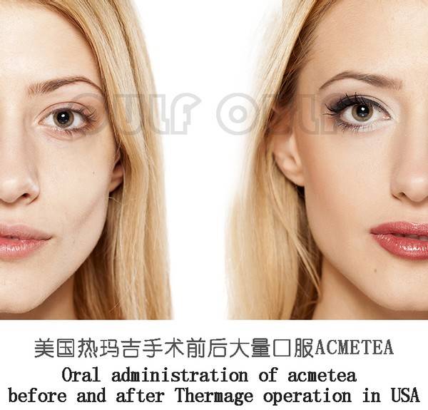 温度深扒做热玛吉全脸部价格表~