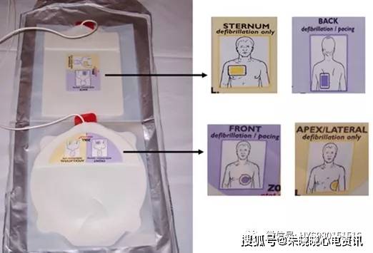 史及查体，确定地高辛和电解质水平，进行系列心电图检查，检测心肌酶。