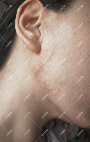 (疤康)瘢痕疙瘩影响美观_患处