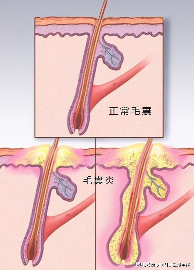 劉翠娥醫生|簡述穿掘性毛囊炎的治療方法