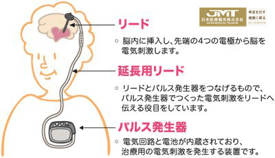 日本起搏器百万人口植入量_心脏起搏器图片(2)