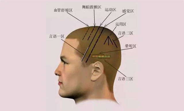 通过刺激头部发际区域的特定部位治疗疾病的一种独特的针灸疗法