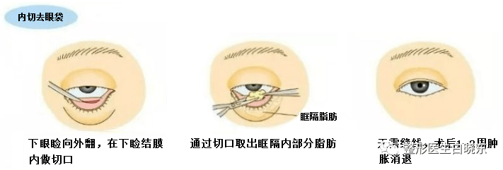 眼袋一直有怎么办