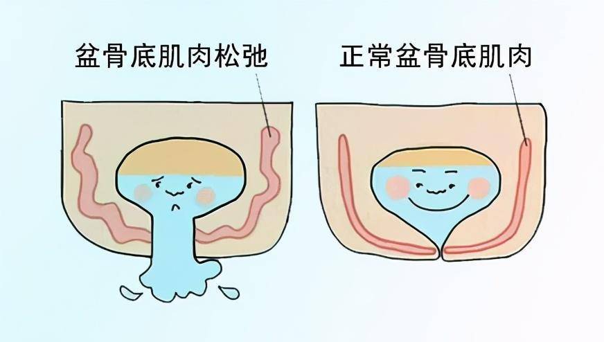 顺产会导致阴道松弛所以选择剖宫产别傻了