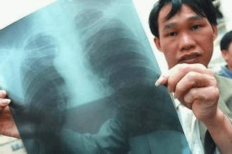 一期尘肺图片图片