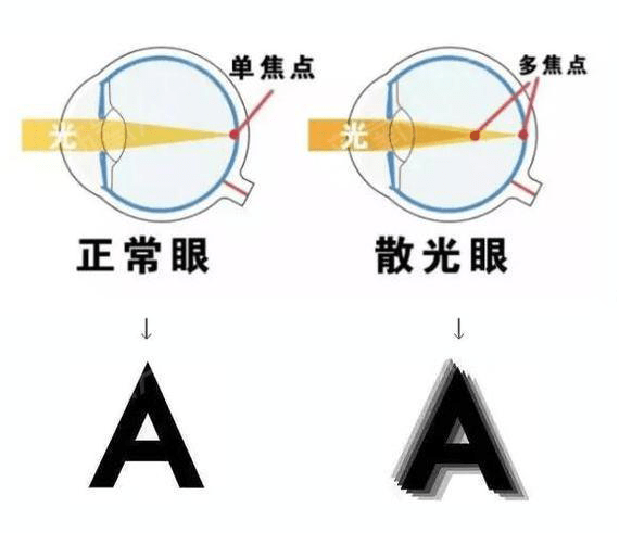 散光科普你是否還在談散色變正確的認識散光