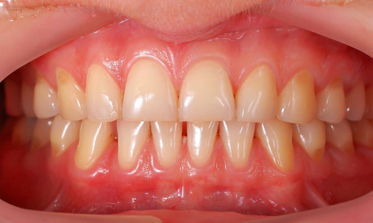 牙床正常图片