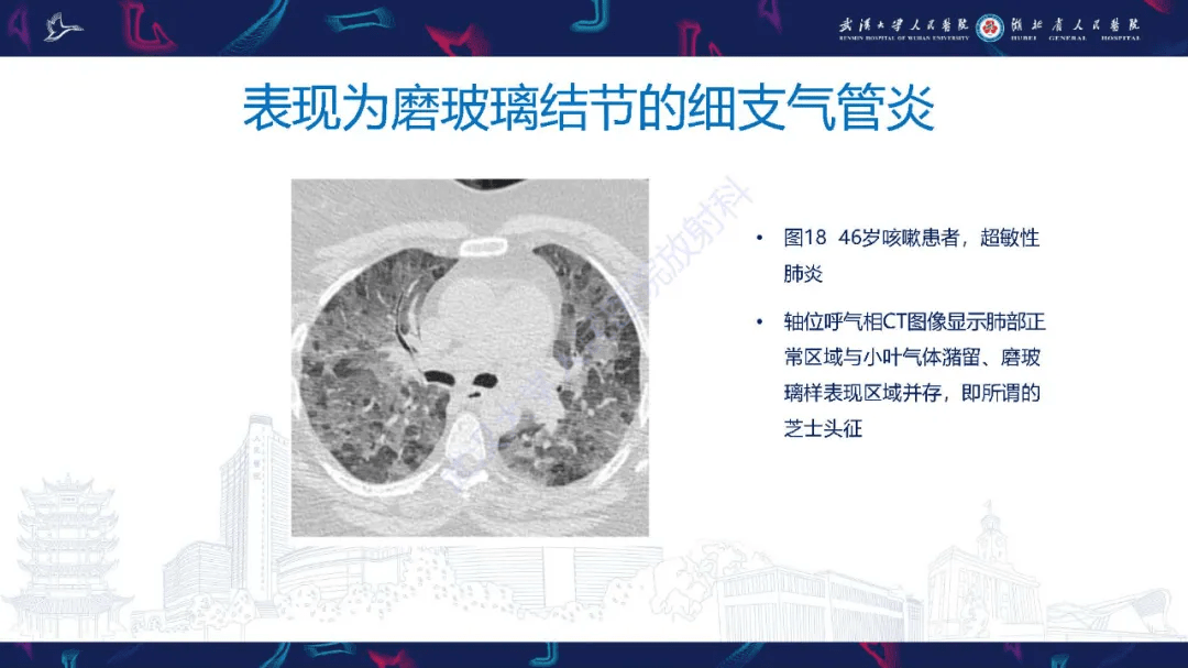 细支气管炎影像诊断