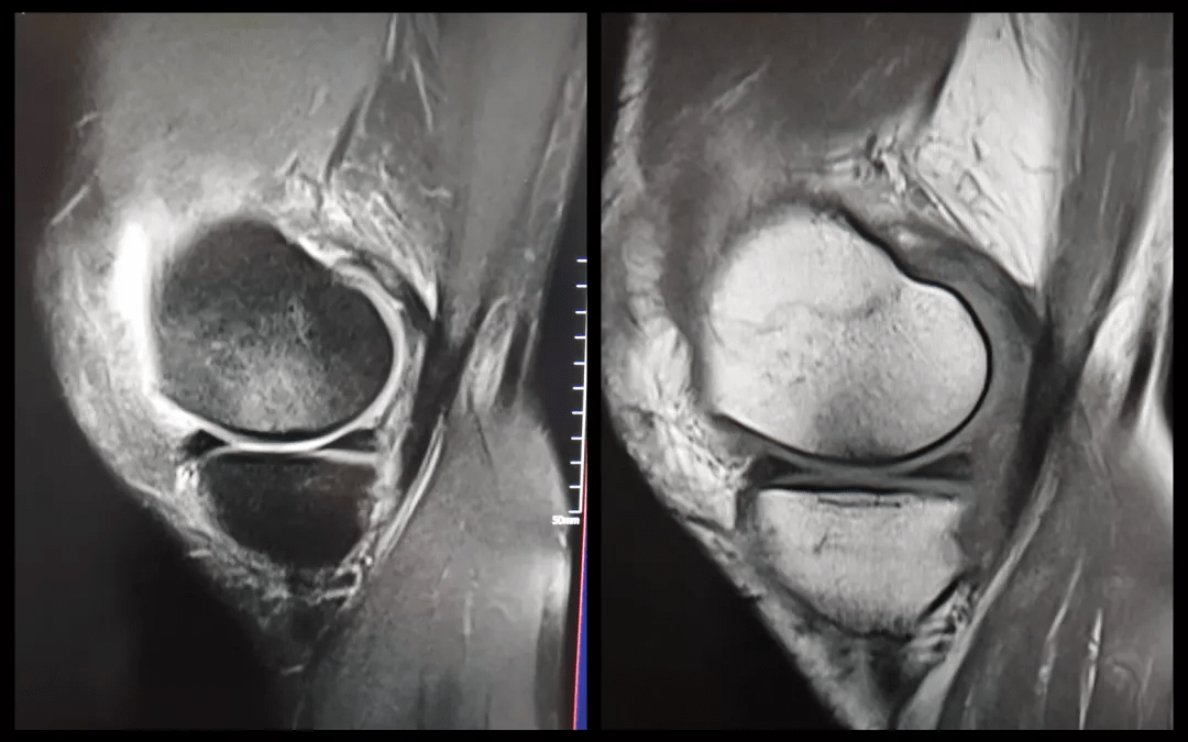 膝關節半月板病變的mri診斷與鑑別