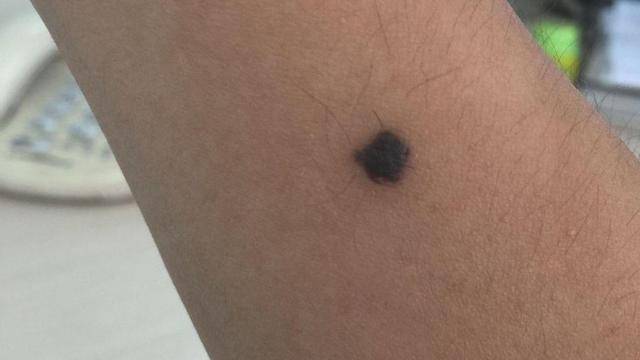 而癌的直径大于5毫米,边缘也不整齐,呈锯齿状,所以如果发现这种痣