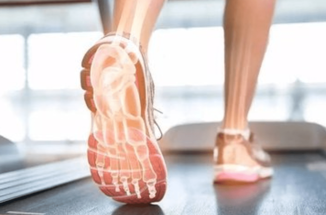 走路如 刀刺 女子每日行两万步 脚足跟竟长出一根 刺 王女士