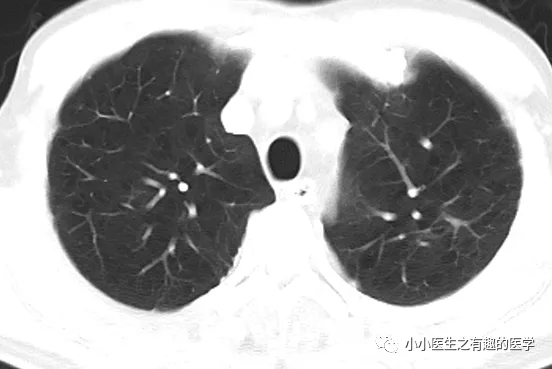 ct經典圖譜:肺氣腫ct典型圖譜,一學就會