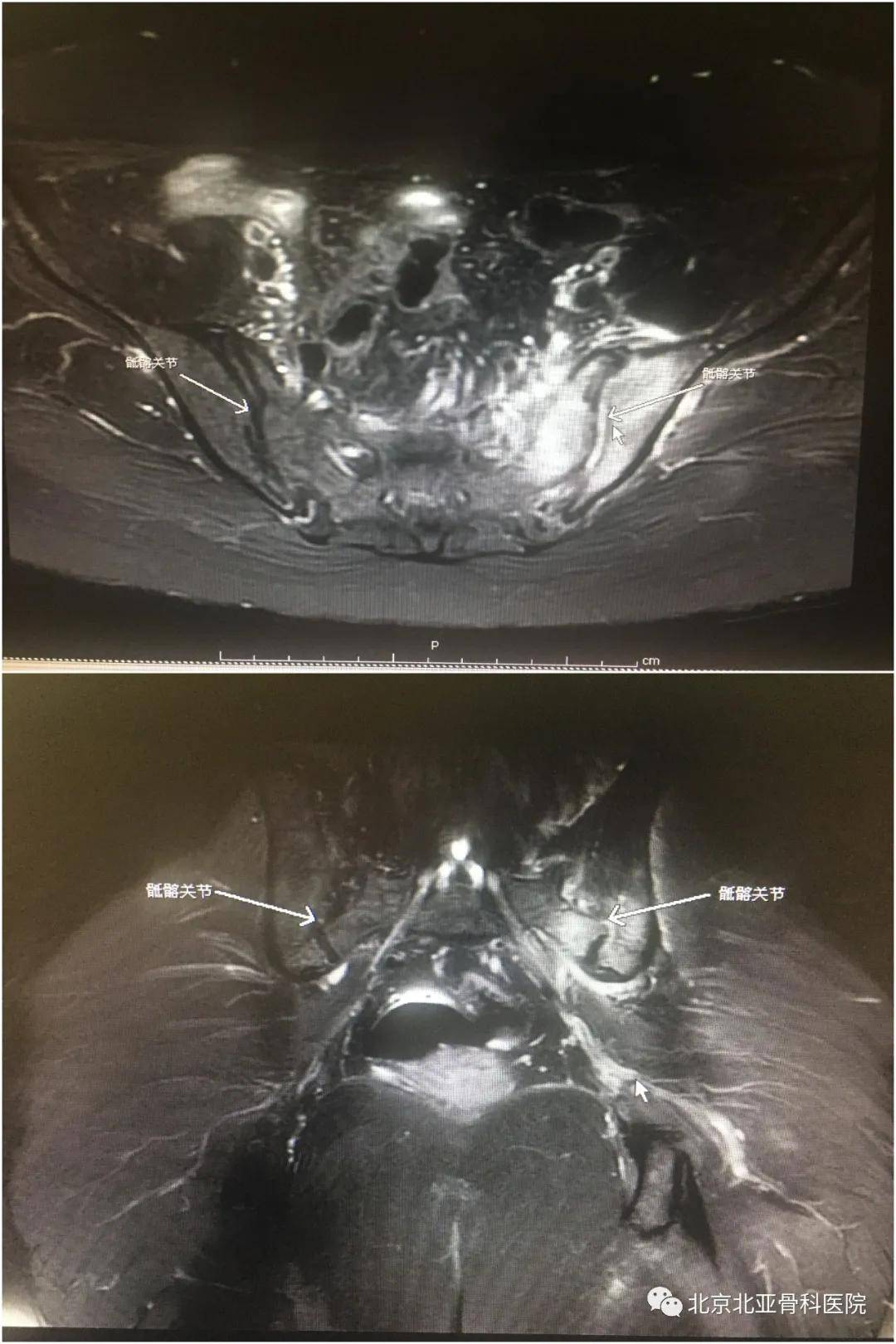 她年紀輕輕卻腰臀部疼痛難忍原因竟然是骶髂關節炎