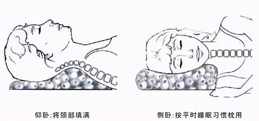 美女十年不枕枕头本意预防驼背没想到颈椎却遭了罪