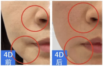 激光|同属抗衰激光，fotona4d与5gmax怎么选？