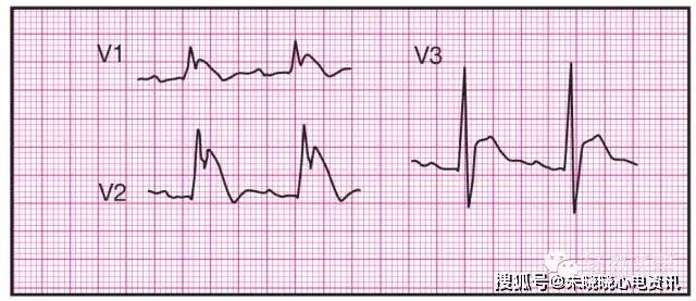 心电图简谱_正常心电图图片(3)