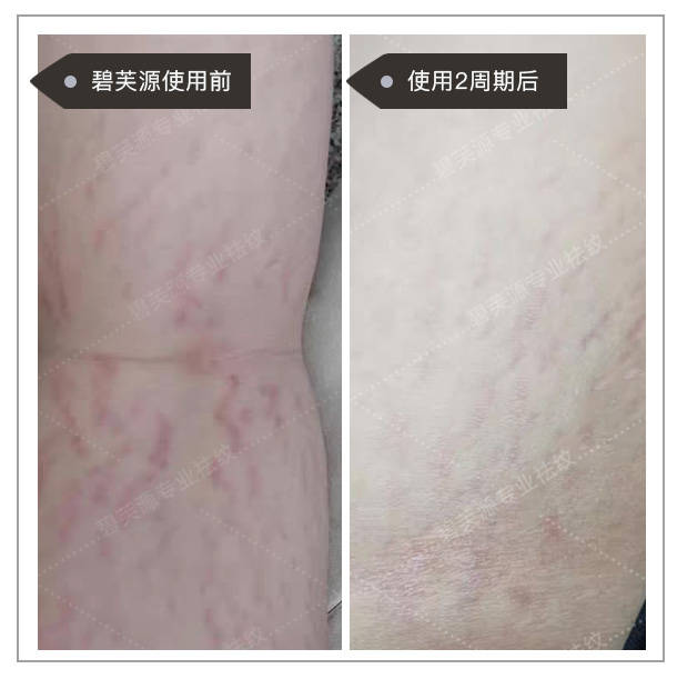 肥胖纹是瘦了还是胖了 4e65435579c841e18b02f44b40fe640e.jpeg