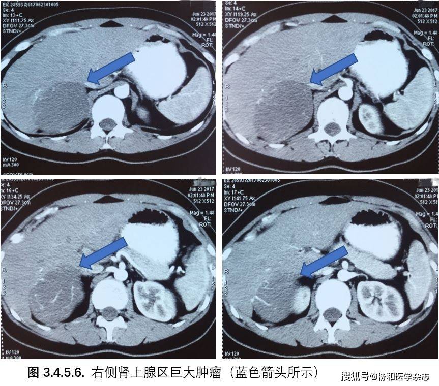 pet/ct檢查:右側腎上腺區可見低密度團塊影,呈不均勻放射性攝取增高